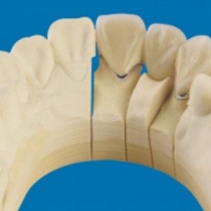 Metall-Porzellanzähne